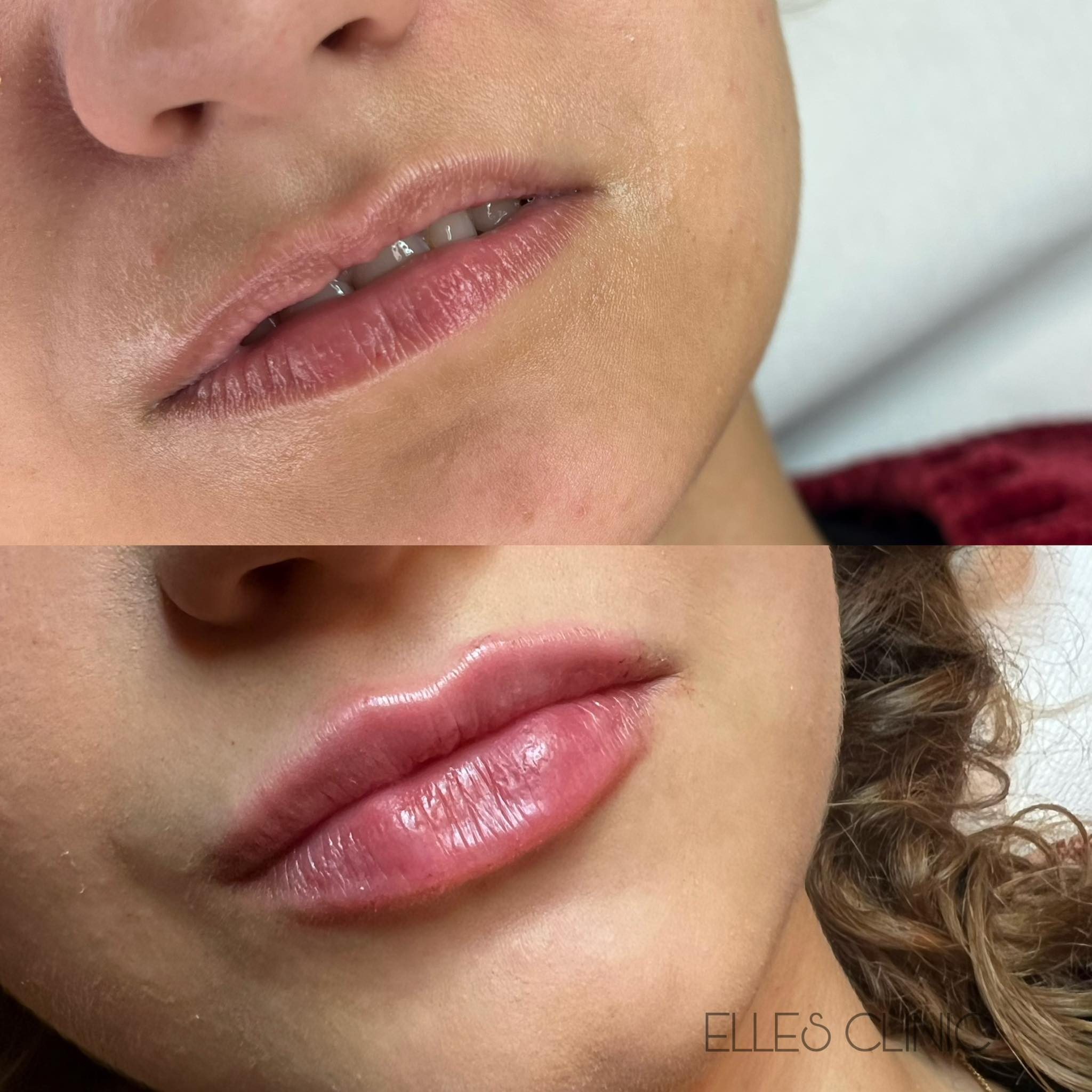 Modelowanie ust – korekta asymetrii i wypełnienie