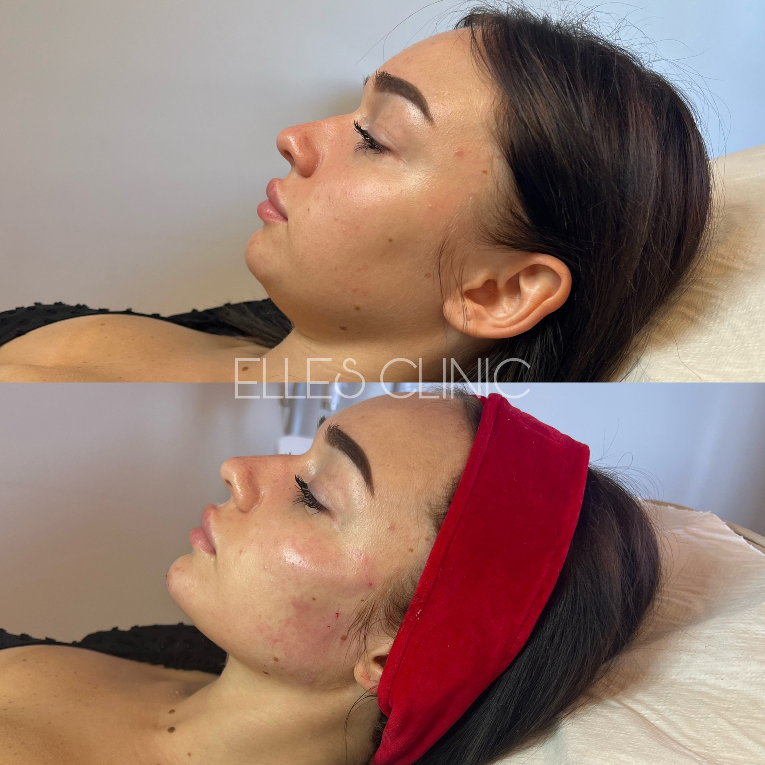 Modelowanie twarzy kwasem hialuronowym – lifting i wymodelowanie policzków