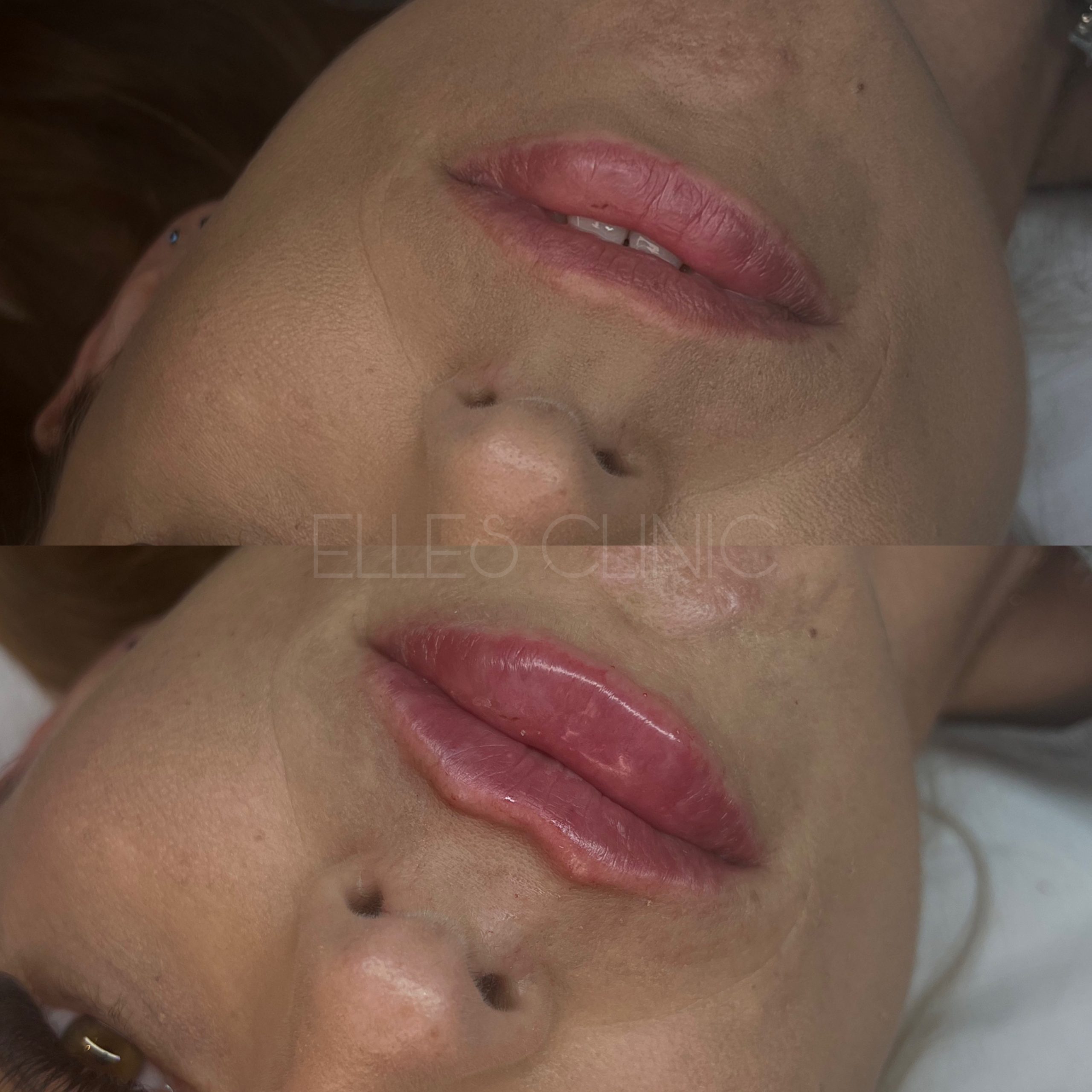 Modelowanie ust kwasem hialuronowym – naturalny efekt wypełnienia i nawilżenia