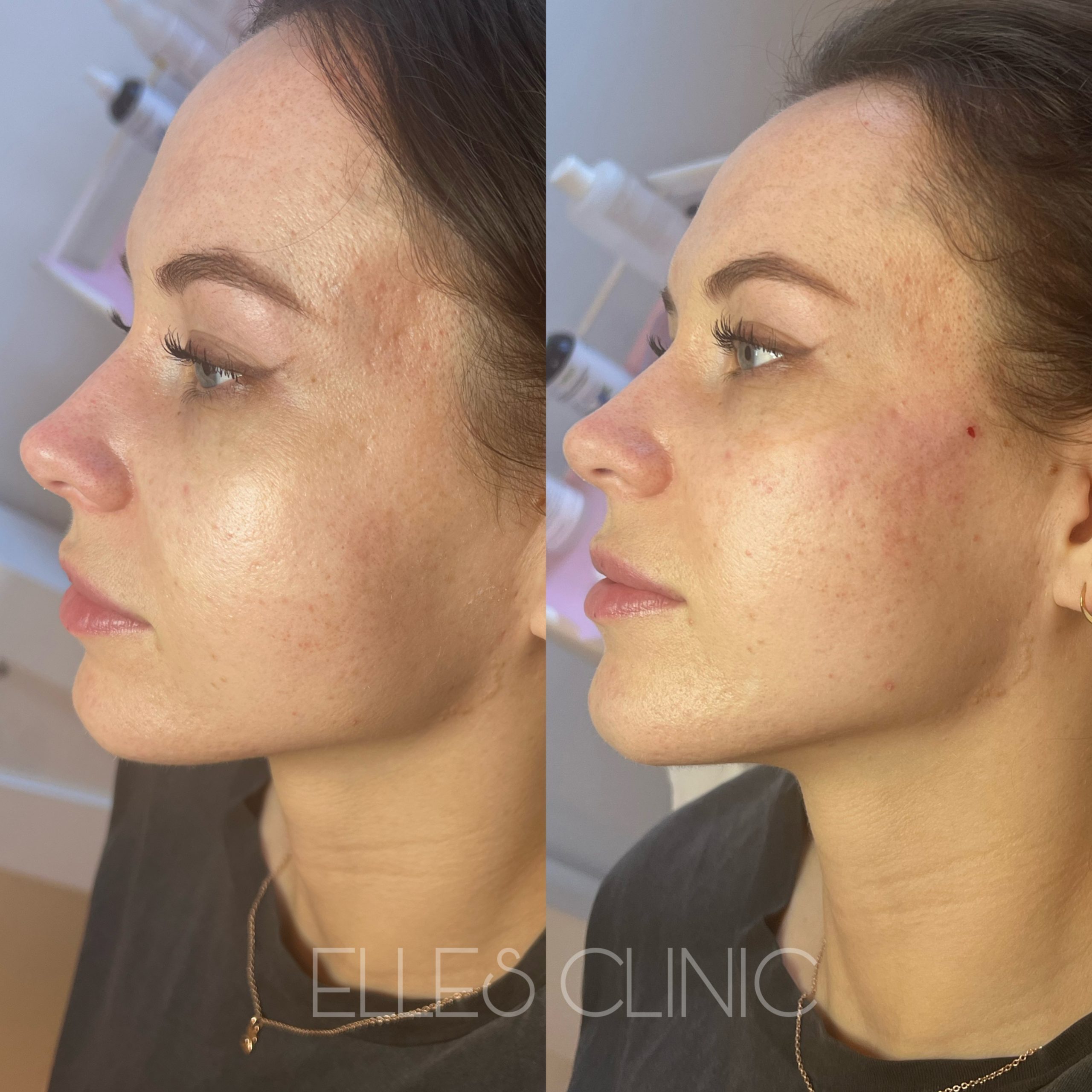 Wolumetria twarzy – modelowanie konturów i przywracanie objętości skóry