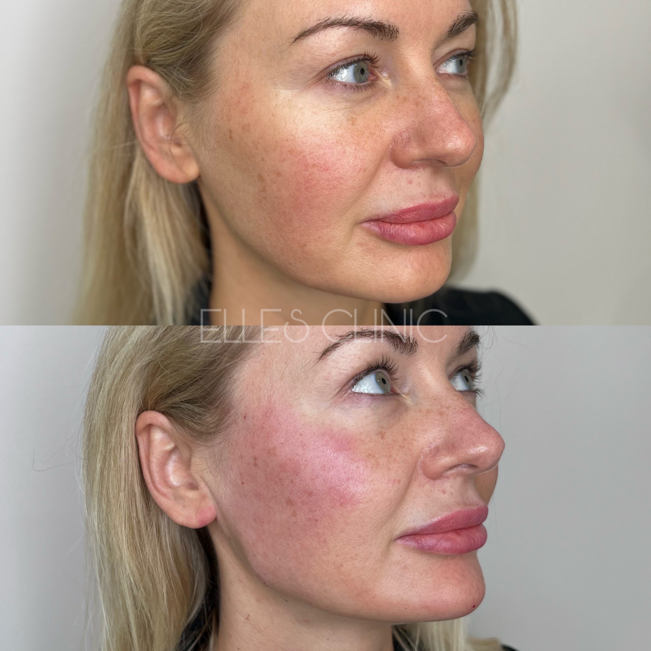 modelowanie twarzy kwasem hialuronowym