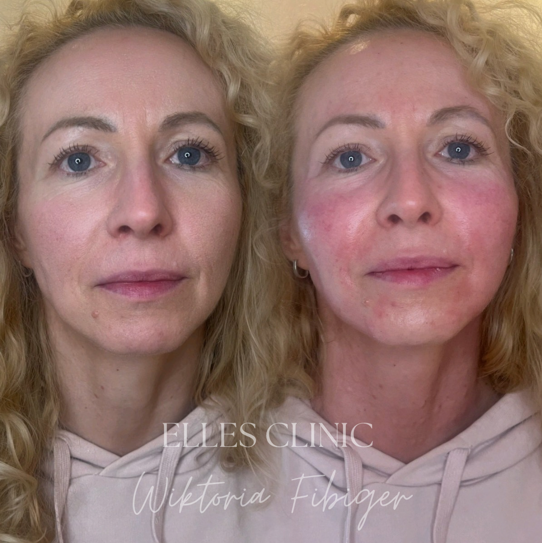 Podanie autologicznego wypełniacza tropokolagenowego z komórkami macierzystymi – naturalny lifting i modelowanie twarzy Warszawa