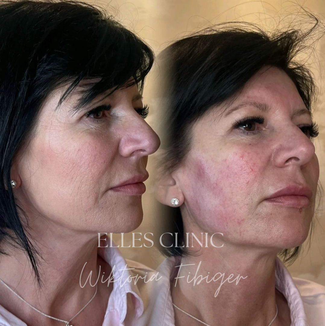 Przygotowanie autologicznego wypełniacza tropokolagenowego z krwi pacjenta – zabieg naturalnego modelowania twarzy Warszawa